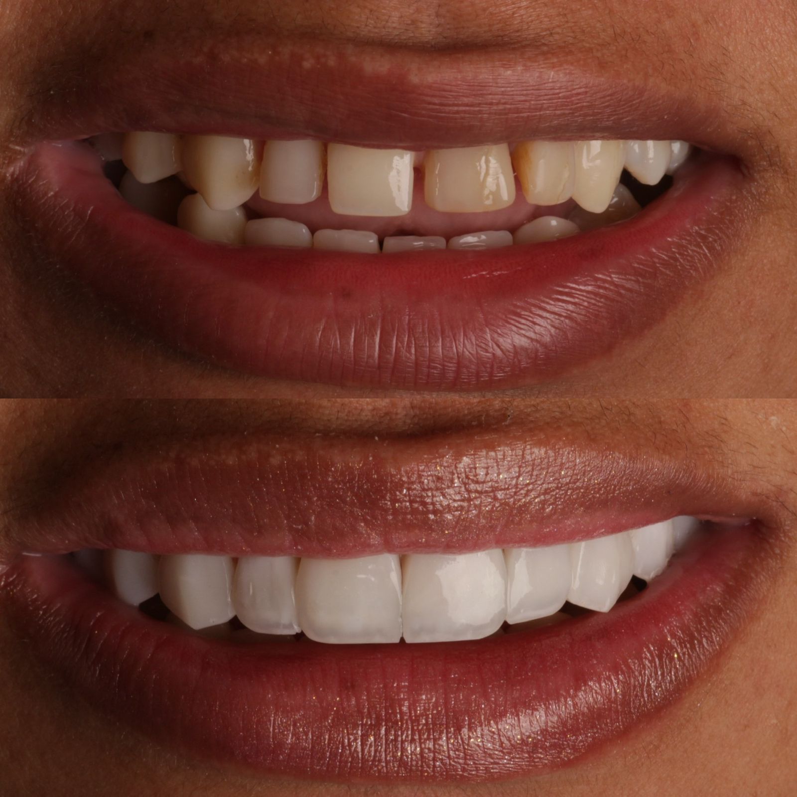 Sorriso para planejamento de facetas dentais